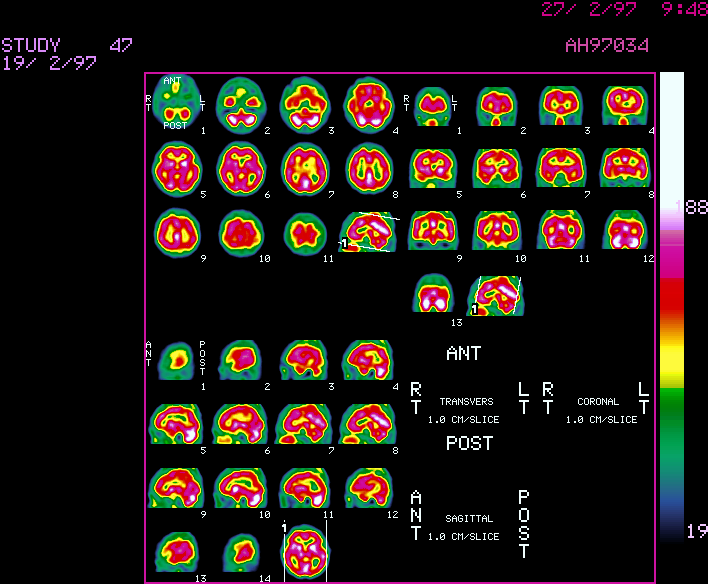 Norml agyi vrtfolys: metszetek
