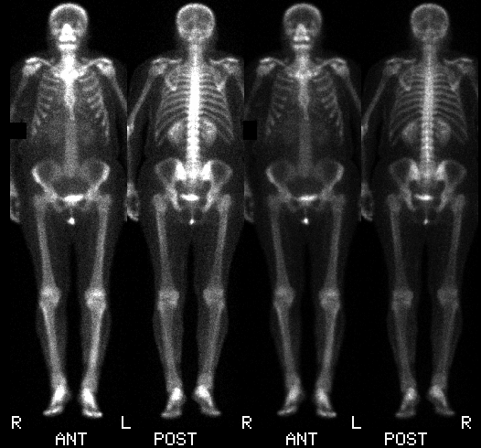 Norm�lis eg�sztest csontszcintigram