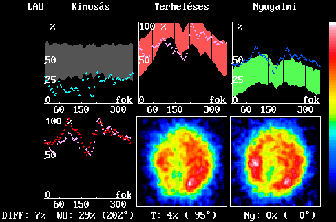 Redisztrib�ci� sz�vizom perf�zi�s szcintigramon