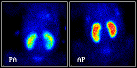 Normlis sztatikus vese